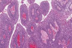 High grade squamous intraepithelial lesion of the anal canal