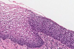 High grade squamous intraepithelial lesion of the cervix