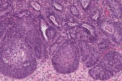 High grade squamous intraepithelial lesion and adenocarcinoma in situ of the cervix