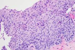 High grade squamous intraepithelial lesion of the vagina