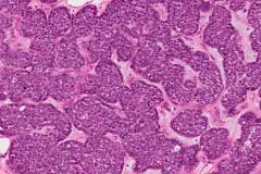 HPV-associated multiphenotypic sinonasal carcinoma