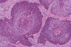 HPV-associated basaloid squamous cell carcinoma of the penis