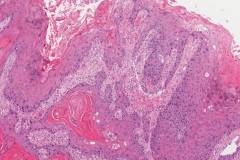 HPV-independent squamous cell carcinoma of the penis