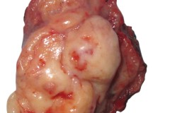 Hyalinizing clear cell carcinoma of the oropharynx