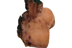 Hyalinizing clear cell carcinoma of the oropharynx