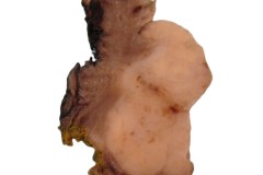 Hyalinizing clear cell carcinoma of the oropharynx