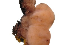 Hyalinizing clear cell carcinoma of the oropharynx