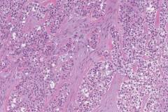 Hyalinizing clear cell carcinoma