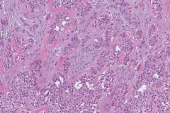 Hyalinizing clear cell carcinoma