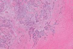 Hyalinizing clear cell carcinoma