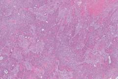 Hyalinizing clear cell carcinoma