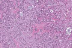 Hyalinizing clear cell carcinoma