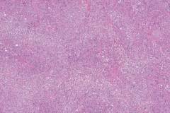 Hyalinizing clear cell carcinoma