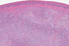 Hyalinizing clear cell carcinoma