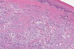 Hyalinizing clear cell carcinoma