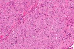Hyalinizing trabecular tumour of the thyroid gland