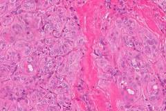 Hyalinizing trabecular tumour of the thyroid gland