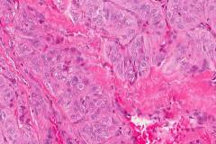 Hyalinizing trabecular tumour of the thyroid gland