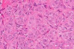 Hyalinizing trabecular tumour of the thyroid gland