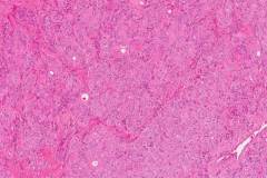 Hyalinizing trabecular tumour of the thyroid gland