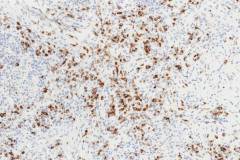 IgG4 related chronic rhinosinusitis