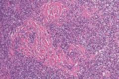 IgG4 related chronic rhinosinusitis