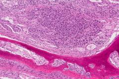 Immature teratoma of the ovary