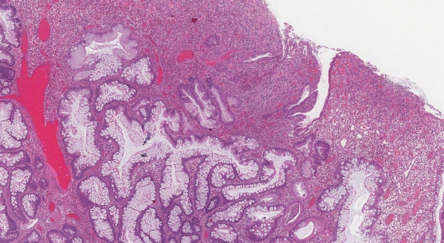 Inflammatory polyp in the colon