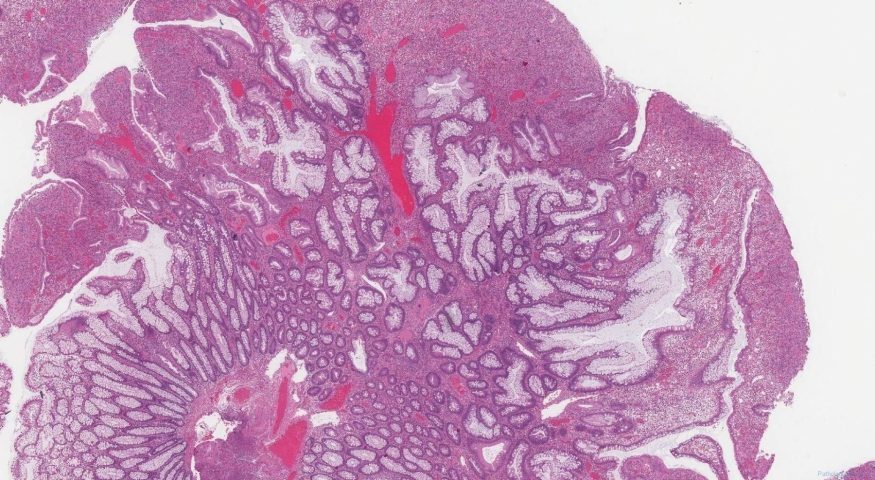 Inflammatory polyp in the colon