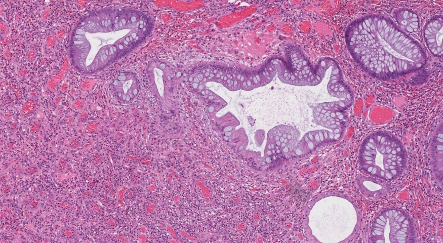 Inflammatory type polyp of the colon