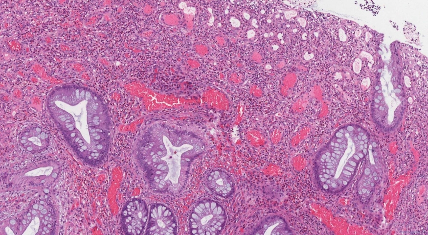Inflammatory type polyp of the colon