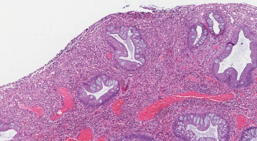 Inflammatory type polyp of the colon