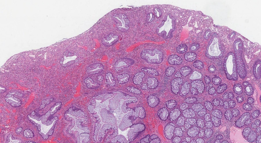 Inflammatory type polyp of the colon