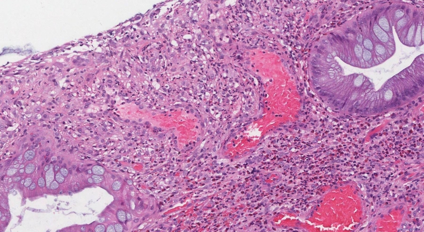 Inflammatory type polyp of the colon