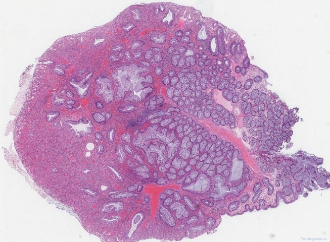 Inflammatory type polyp of the colon