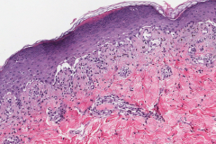 Interface dermatitis with early subepidermal blister