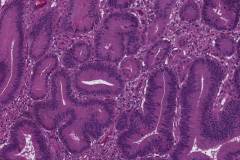 Intracholecystic papillary neoplasm: intestinal type