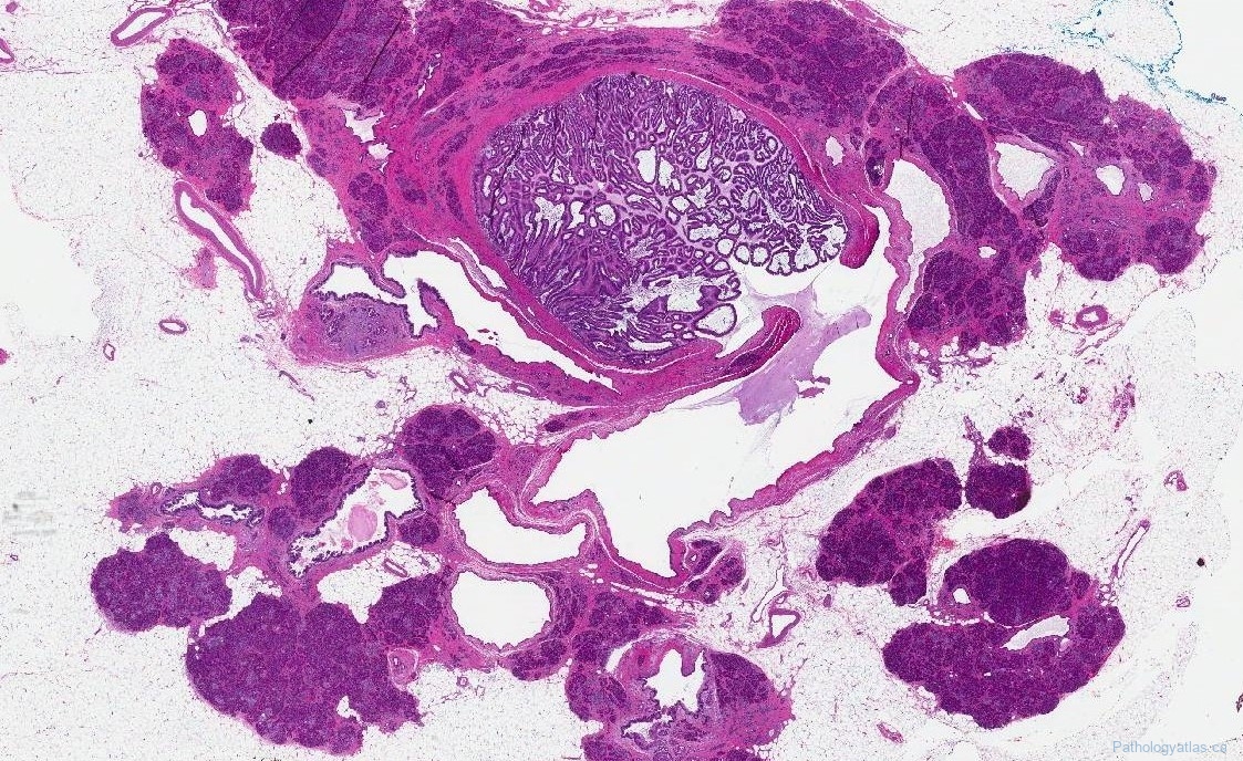 intraductal papillary mucinous neoplasm of pancreas icd 10 code