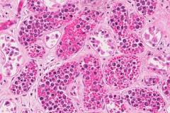 Intravascular diffuse large B cell lymphoma