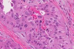 Invasive ductal carcinoma with apocrine features of the breast