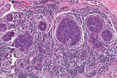 Invasive ductal carcinoma arising from ductal carcinoma in situ of the breast