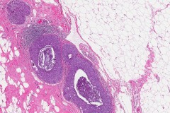 Pleomorphic lobular carcinoma in situ of the breast