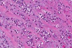 Invasive pleomorphic lobular carcinoma of the breast