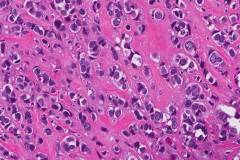 Invasive pleomorphic lobular carcinoma of the breast
