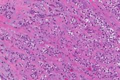 Invasive pleomorphic lobular carcinoma of the breast