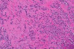 Invasive pleomorphic lobular carcinoma of the breast