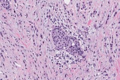 Invasive lobular carcinoma arising from lobular carcinoma in situ of the breast