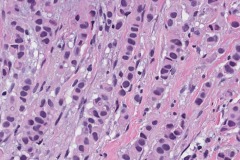 Invasive lobular carcinoma of the breast