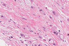 Invasive lobular carcinoma of the breast