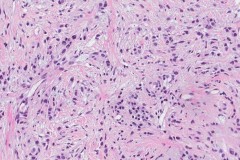Invasive lobular carcinoma of the breast